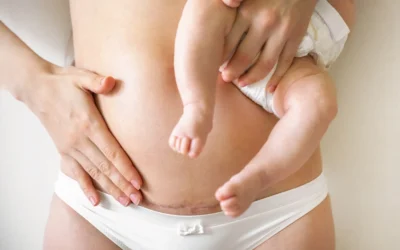 Everything You Want to Know About Cesarean Births